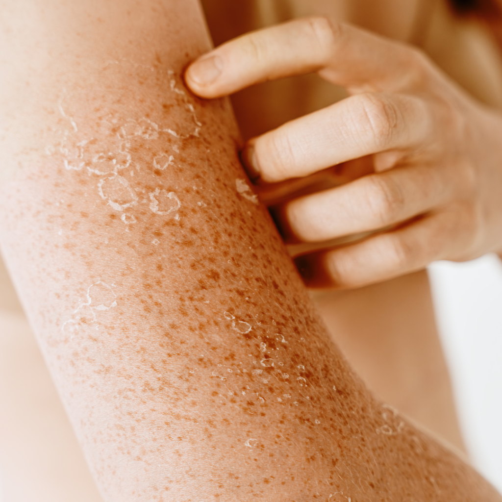 How to Treat Sensitive Skin Naturally at Home